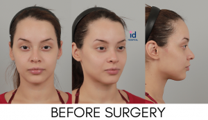 Facial contouring, vline, forehead reduction 