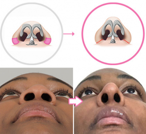 Alarplasty: Before and After