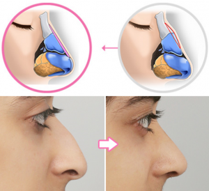 Hump removal: Before and After