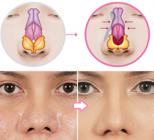 Osteotomy: Before and After