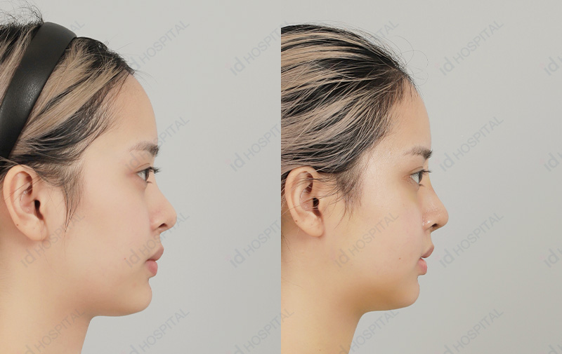 asian rhinoplasty before and after