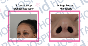 plastic surgery before and after