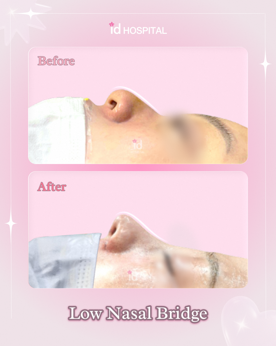 01_bna-Low Nasal Bridge