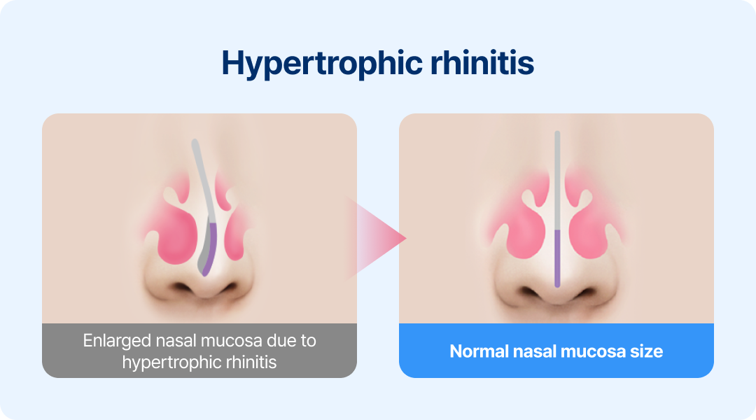 Hypertrophic rhinitis