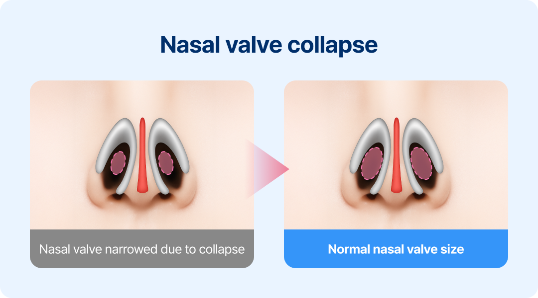 Nasal valve collapse