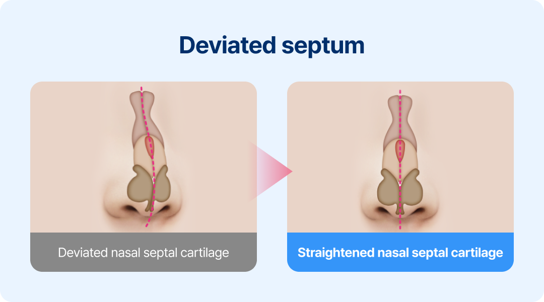 Deviated septum.
