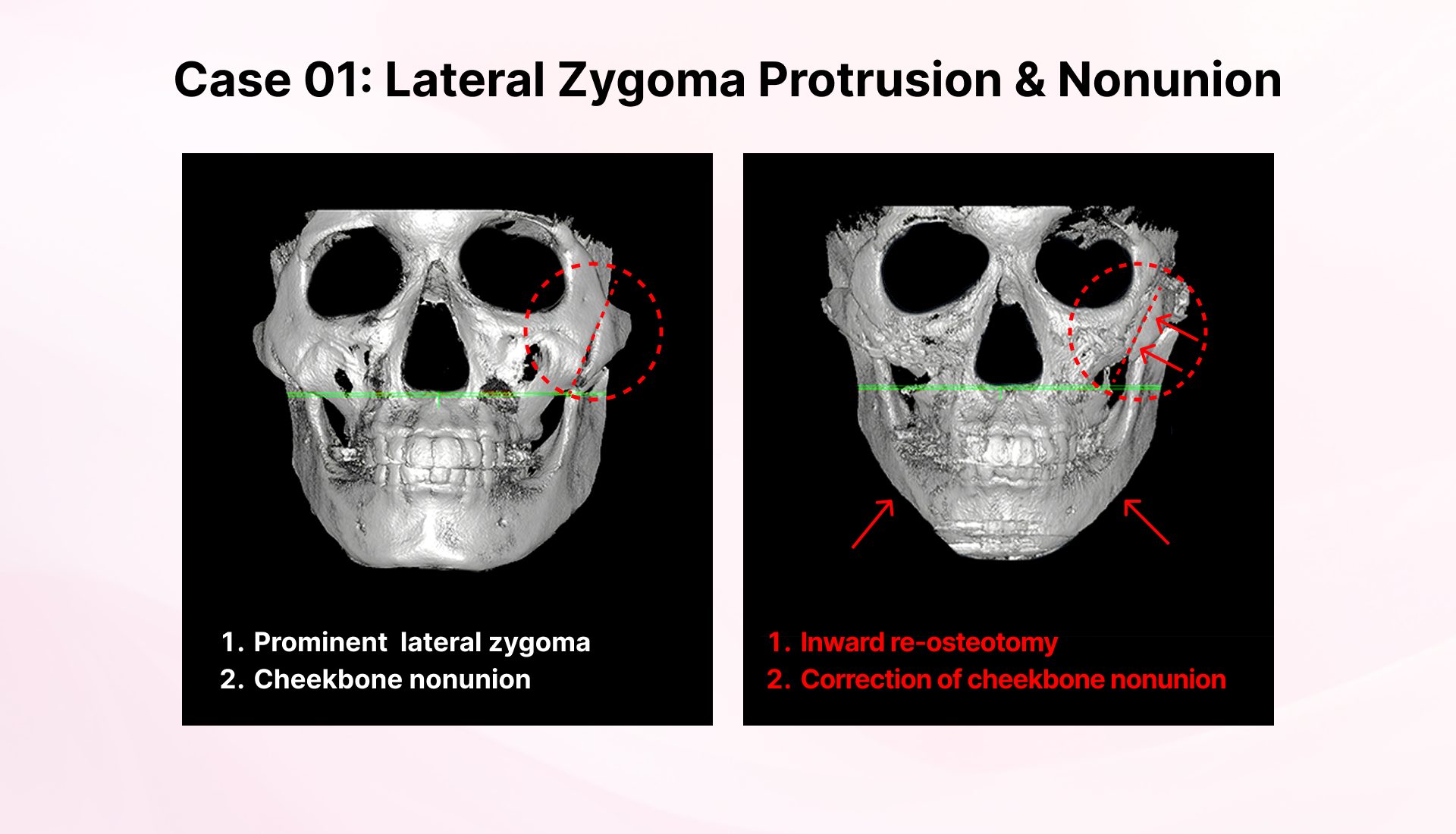 ateral Zygoma Protrusion & Nonunion