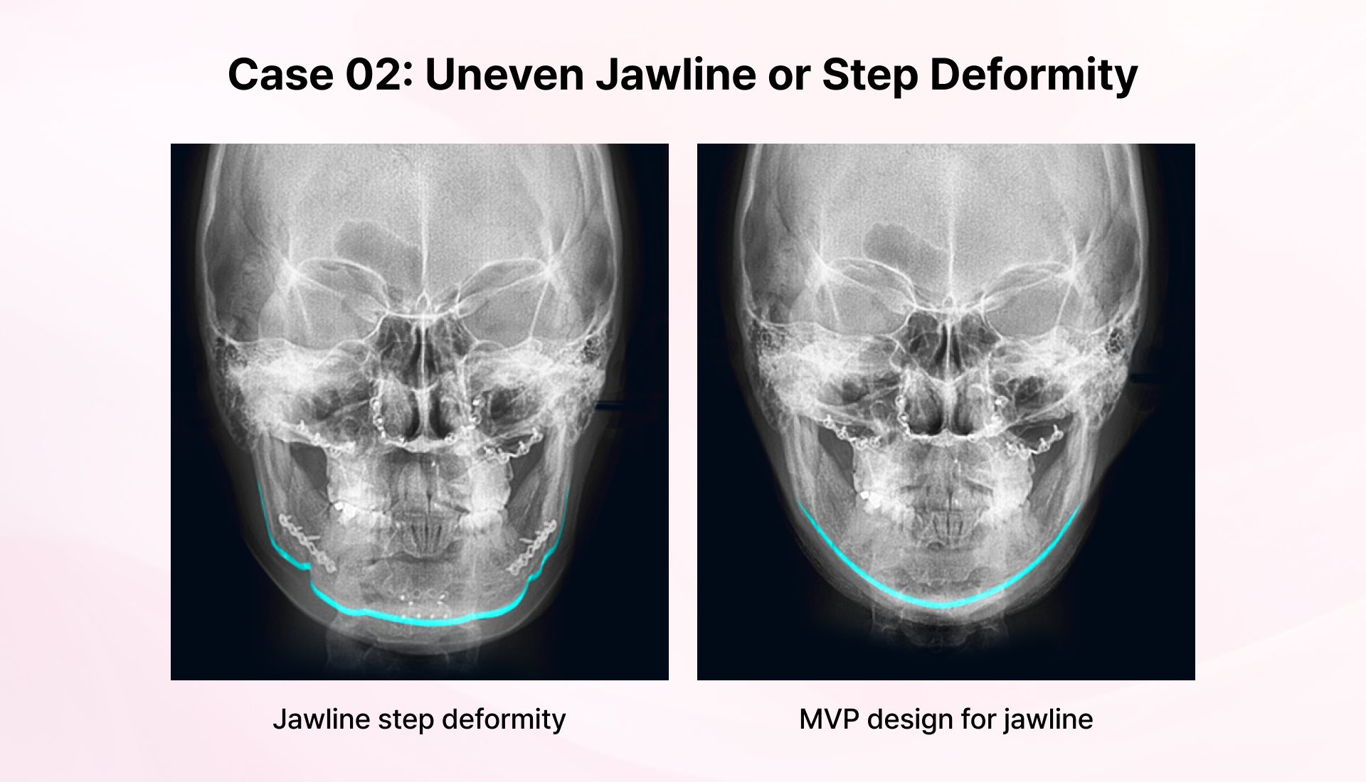Uneven Jawline or Step Deformity