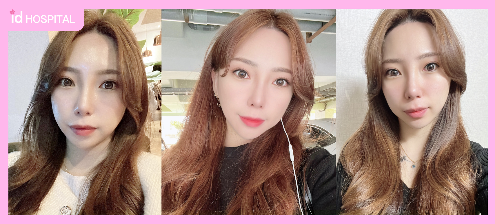  Scar-free results of zygoma reduction in Korea, smaller face look