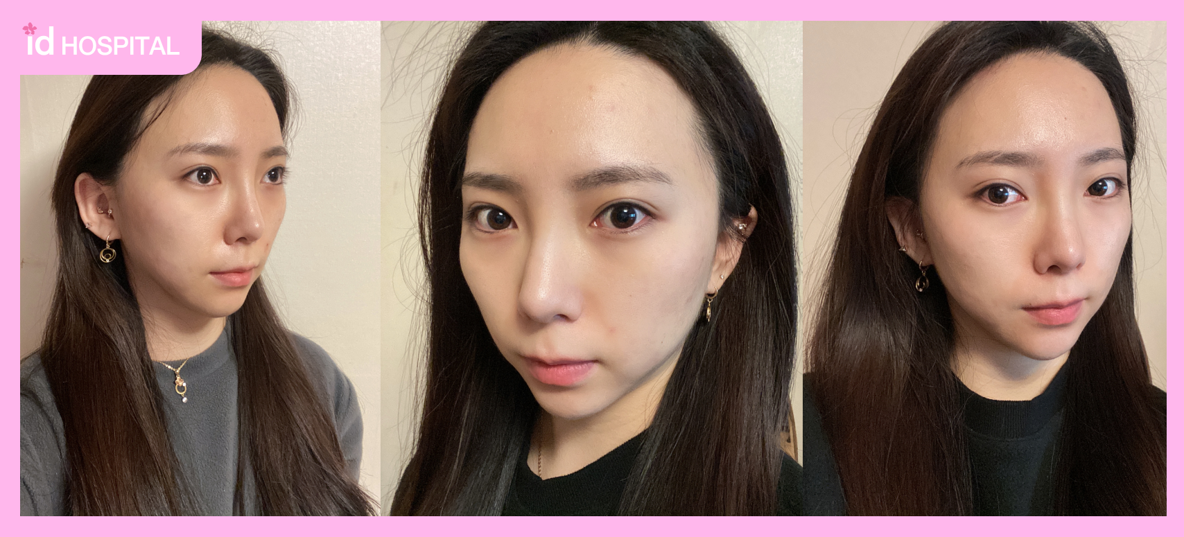 Zygoma Reduction in Korea before surgery, wide forehead and protruding cheekbones