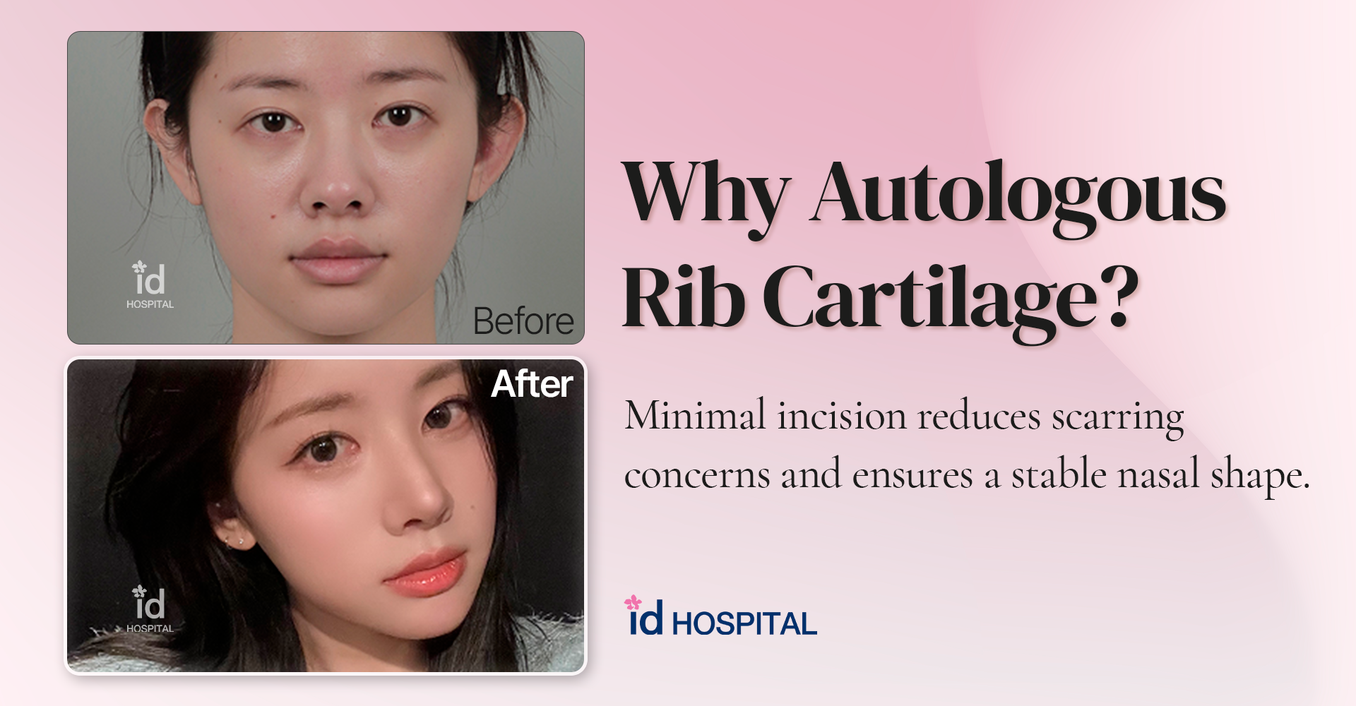 Autologous Rib Cartilage Rhinoplasty: The Final Stop for Nose Revision | id Hospital