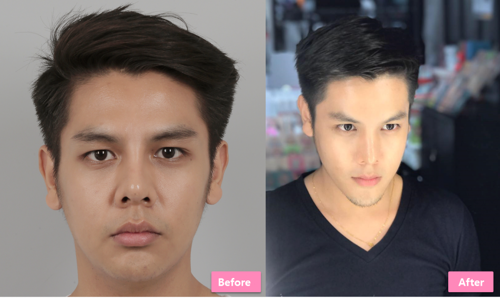 Revision rhinoplasty surgery