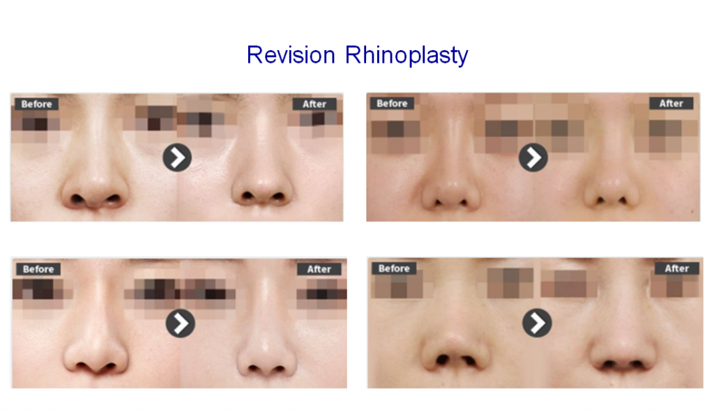Revision rhinoplasty surgery