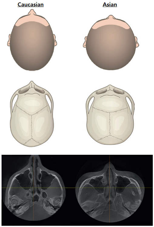 zygoma reduction surgery