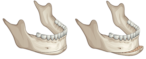elongate a short chin