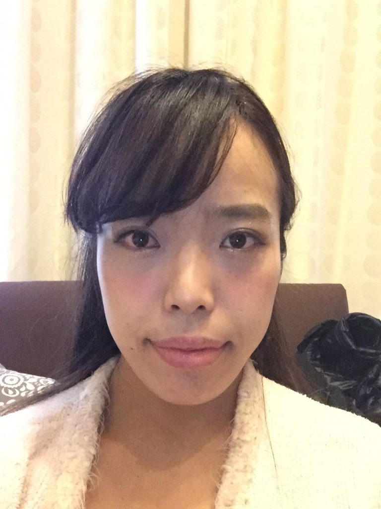 Naoko Facial bone surgeries