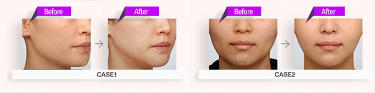 non-surgical facial contouring