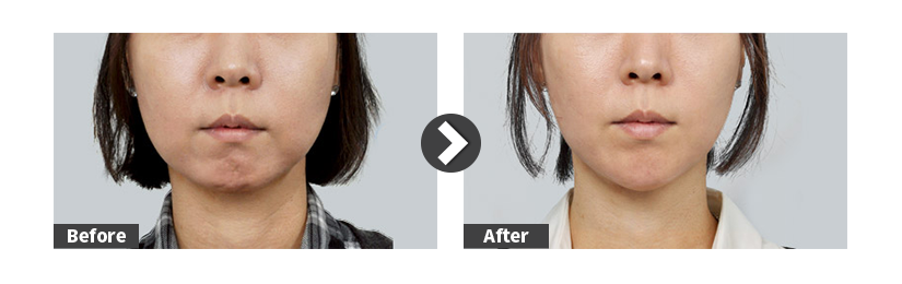non-surgical facial contouring