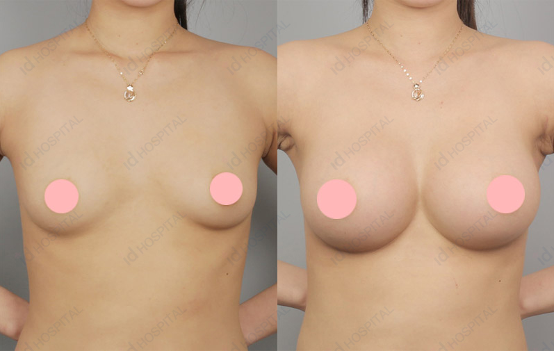 Asian breast augmentation