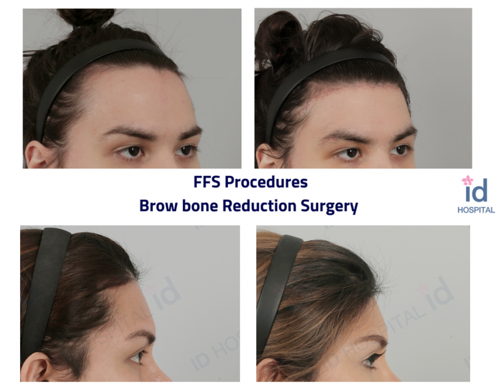 Facial feminization surgery cost