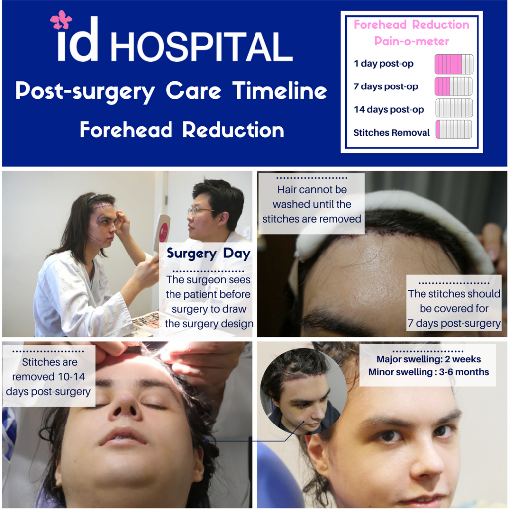Recovery Process for forehead reduction surgery