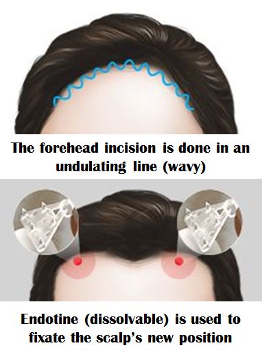 forehead reduction surgery