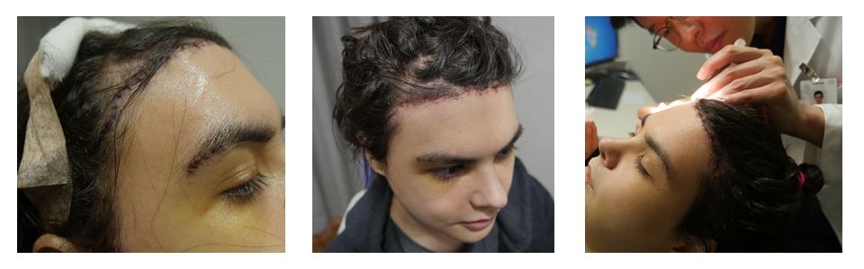 Recovery Process for forehead reduction surgery