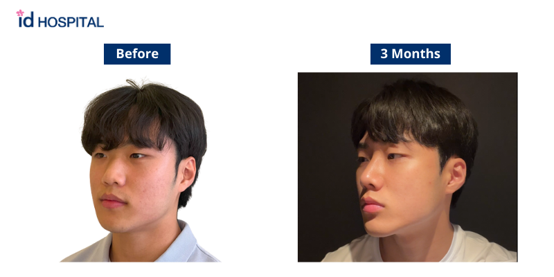 David Kim’s Story of Rhinoplasty at ID Hospital – The No.1 Korean ...
